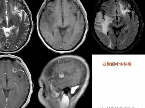 穆西亚拉首次发病，神经系统疾病导致随机意识丧失