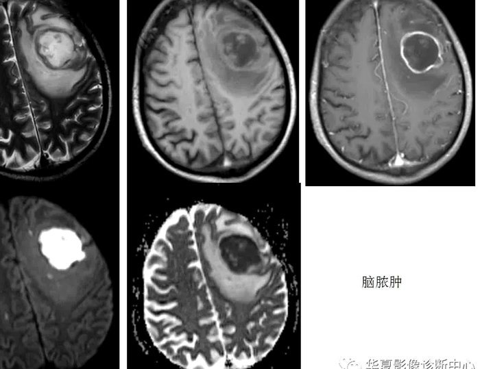 TZ：穆西亚拉穆神经系统疾病去年首次发作，会随机失去意识
