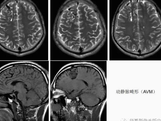 TZ：穆西亚拉穆神经系统疾病去年首次发作，会随机失去意识